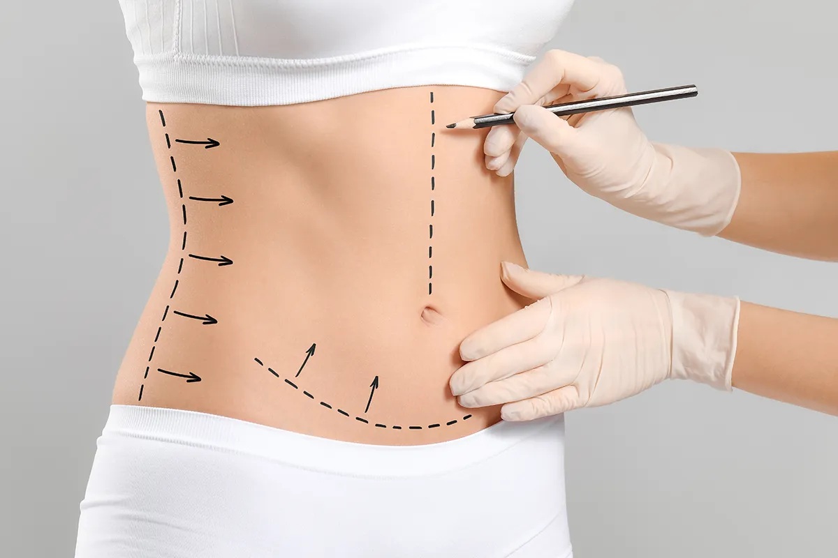 How to Prepare for Abdominoplasty: Essential Tips for a Smooth Recovery